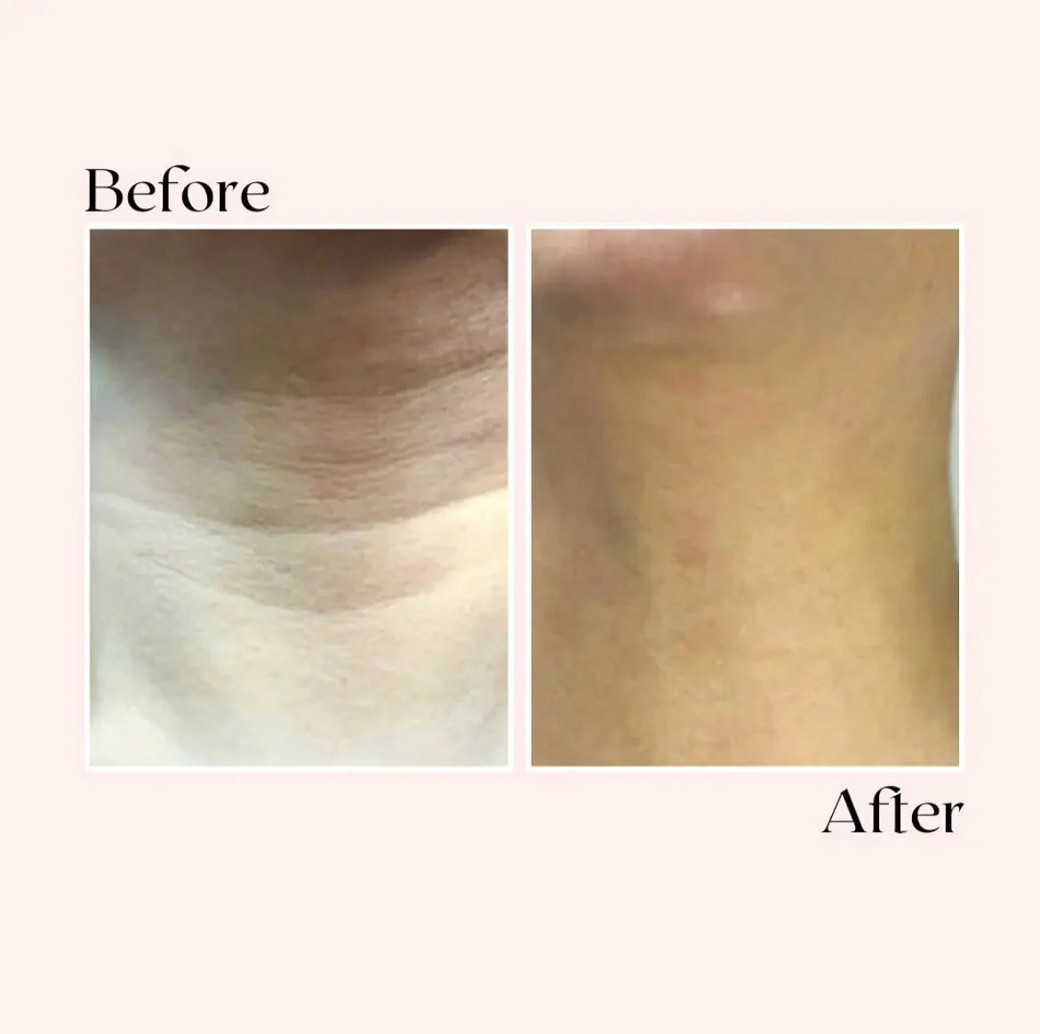Micro Infusion Facial System